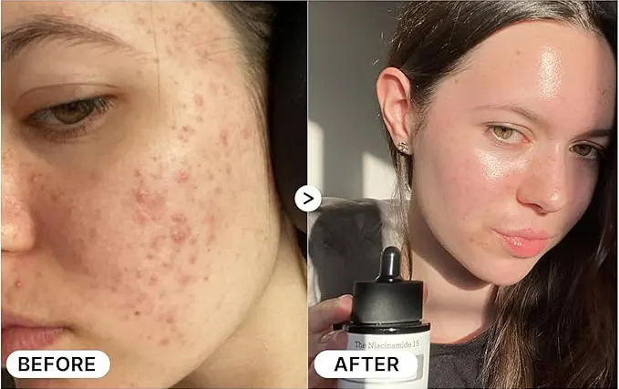 سيروم النياسيناميد 15 كوزراكس سيروم للبشرة، 20 مل.